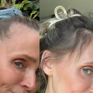 Hair Loss Solution Australia