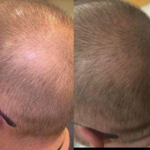 Hair Loss Treatment Australia
