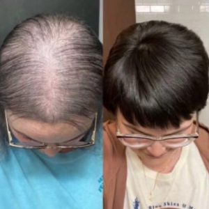 Hair Transformation - Bye Bye Hair Thinning