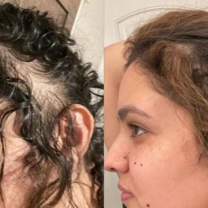 No more thinning hair Perth