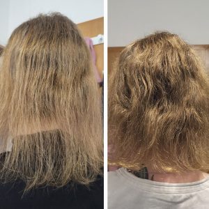 Treatment for Hair Loss Australia